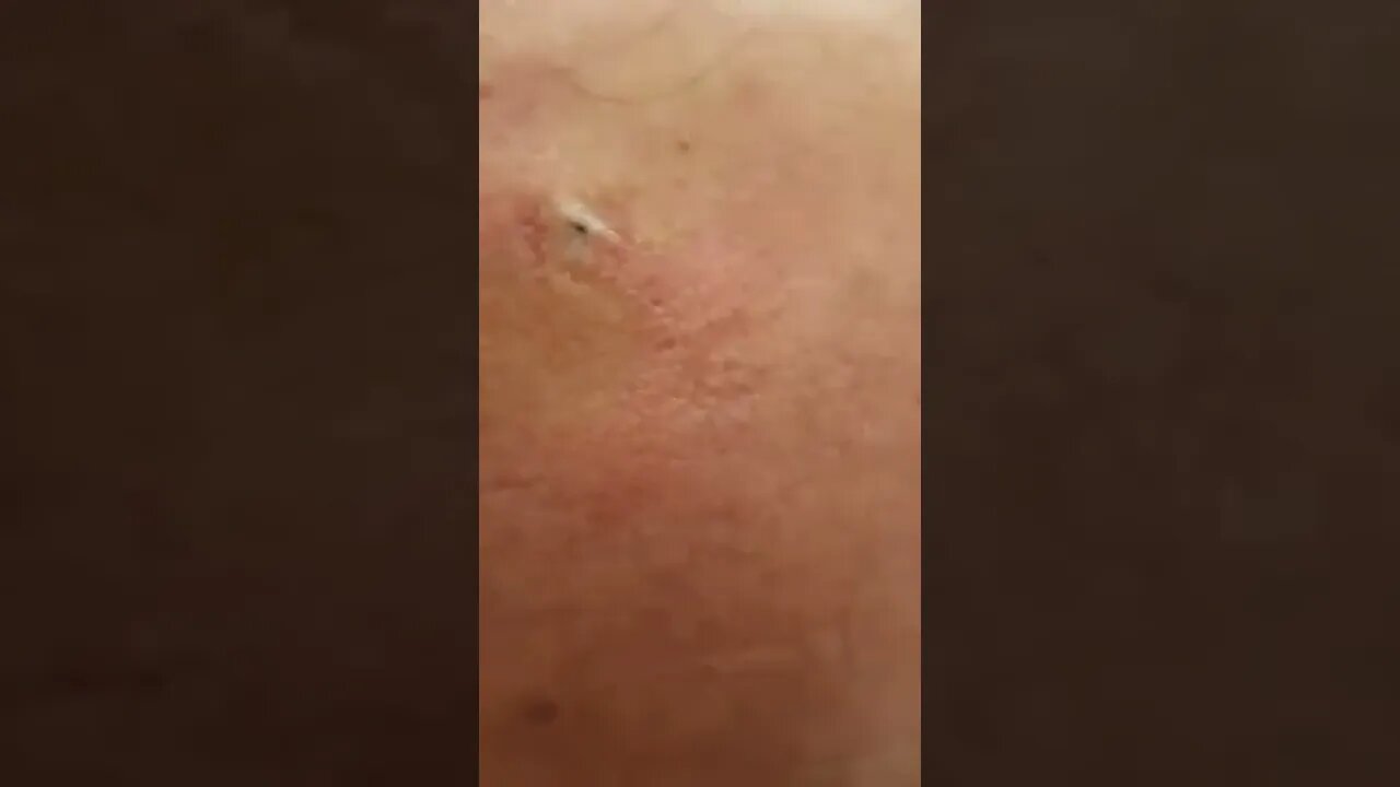 Remoção de Cravos e Espinhas - Remove Squeezing Blackheads and Pimples - Just Relax | Apenas Relaxe