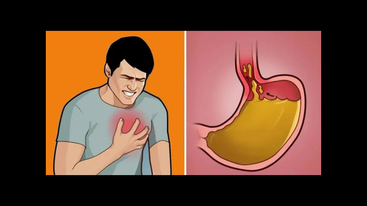 Could my acid reflux get worse with stress?
