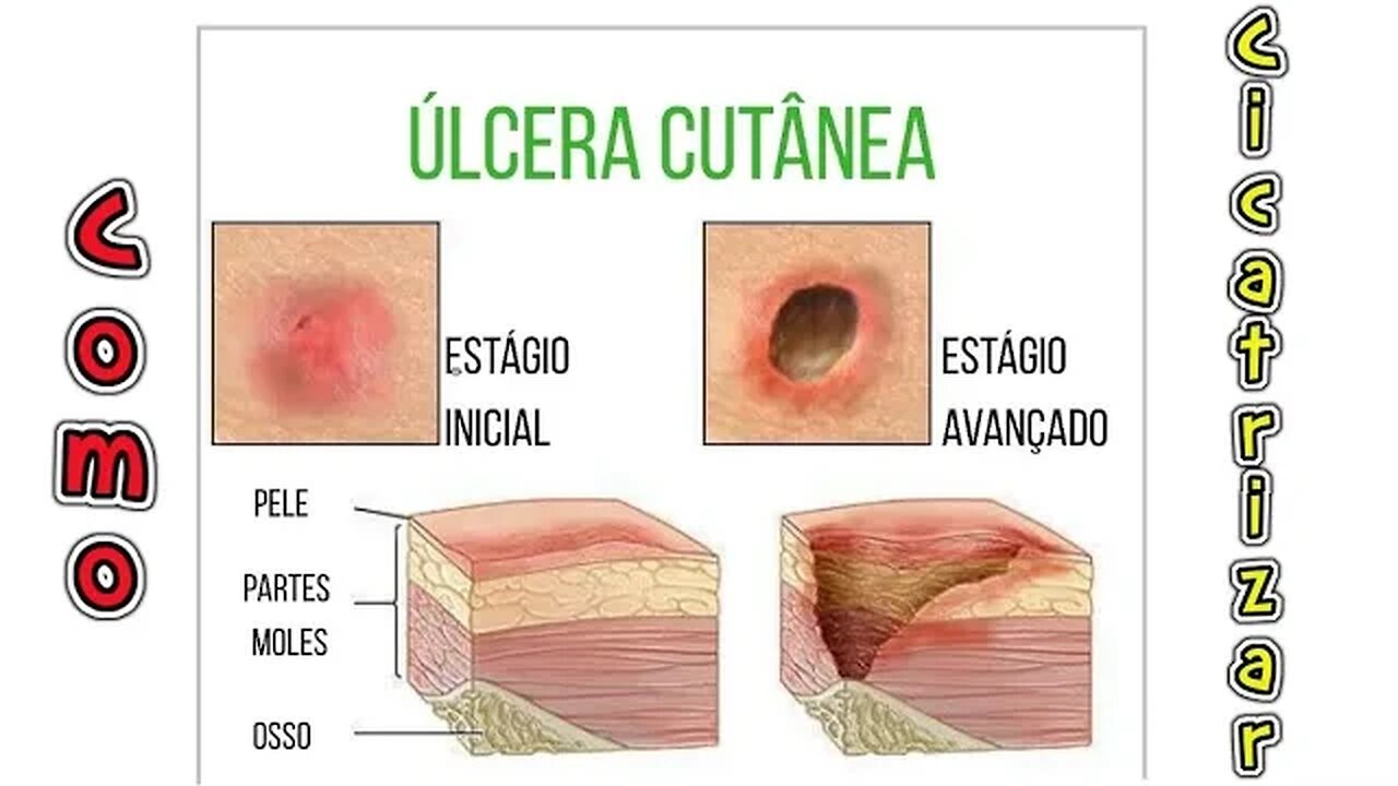 Como Curar Úlceras na Pele - Ferida Tipo Pequena Úlcera na Pele Como Fazer Cicatrizar