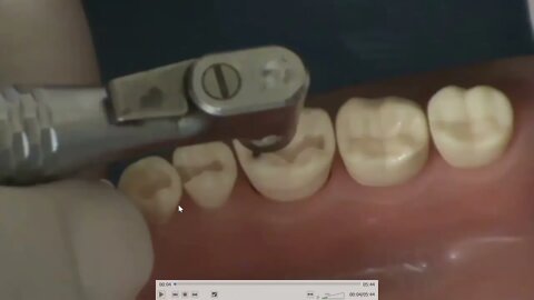 Class II (MOD) Lower First Molar