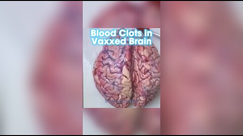 The Human Brain Has Blood Clots After Bill Gates' & Fauci's Death Shot