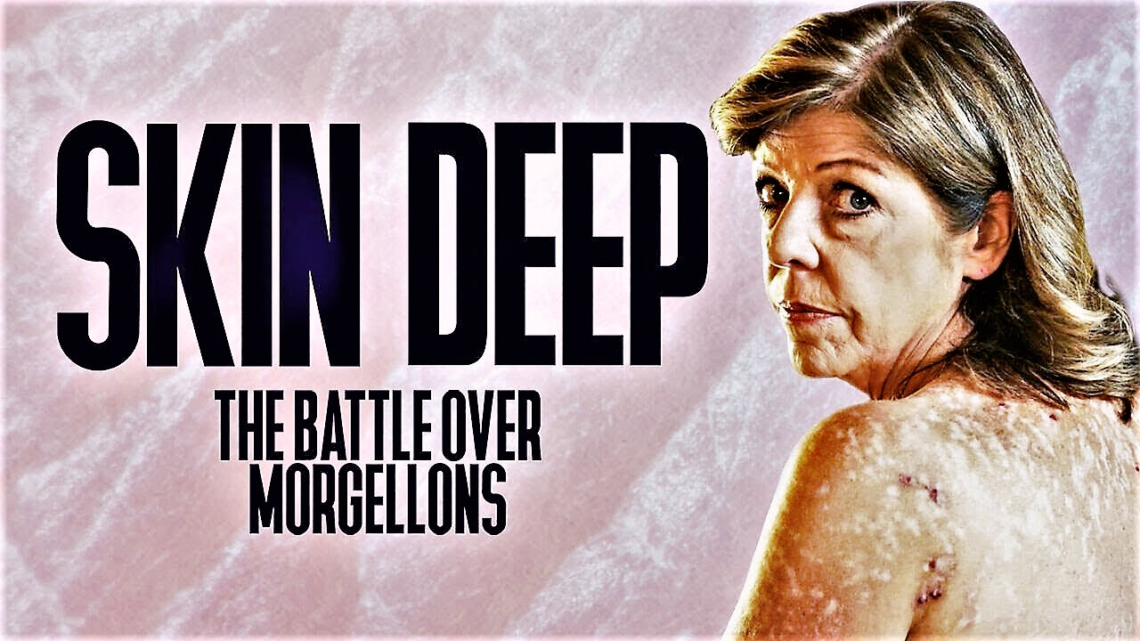 Skin Deep: The Battle Over Morgellons (2019) - Documentary