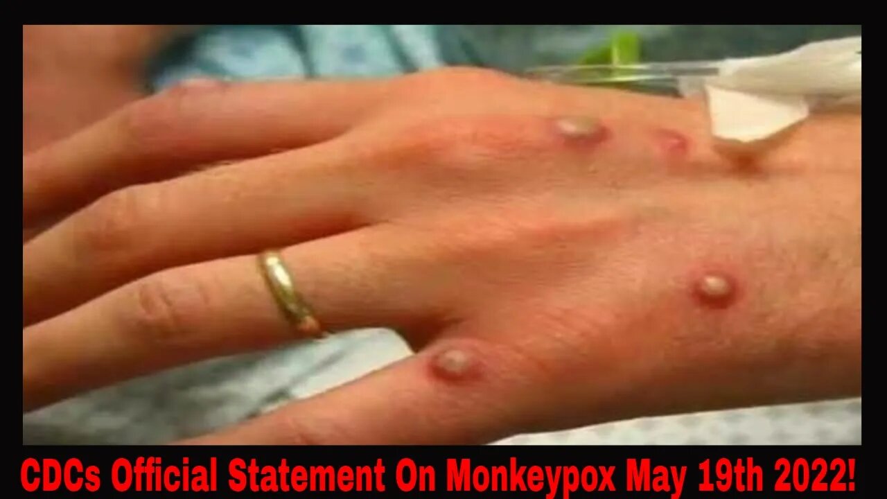The CDC Official Statement On Monkeypox! Not Good!