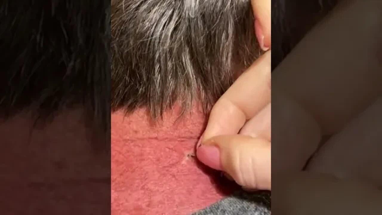 Lil blackhead turns out to be tall | Oddly Satisfying Videos