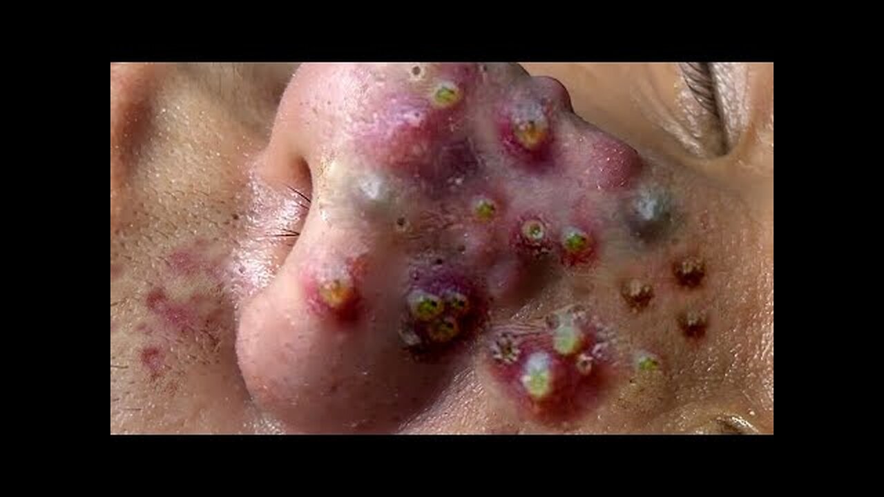 Satisfying blackheads removal Pimple Popper