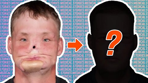 The Face Transplant that Changed his Life