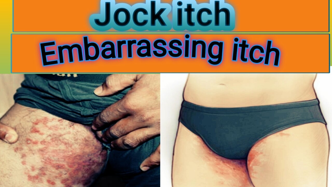 jock itch treatment/ tinea treatment/ringworm treatment/ fungal treatment/groin fungus treatment