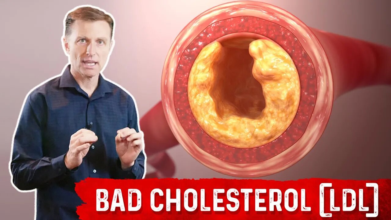 Bad Cholesterol (LDL) is NOT Cholesterol and Is NOT Bad! – Dr.Berg