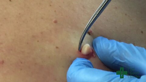 Removal of an Epidermal Cyst along the midback