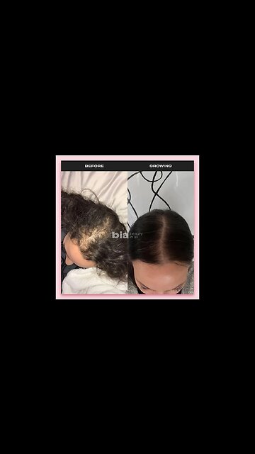 My Hair Growth Routine | Natural and Effective Anti-hair Loss Routine! #Shorts