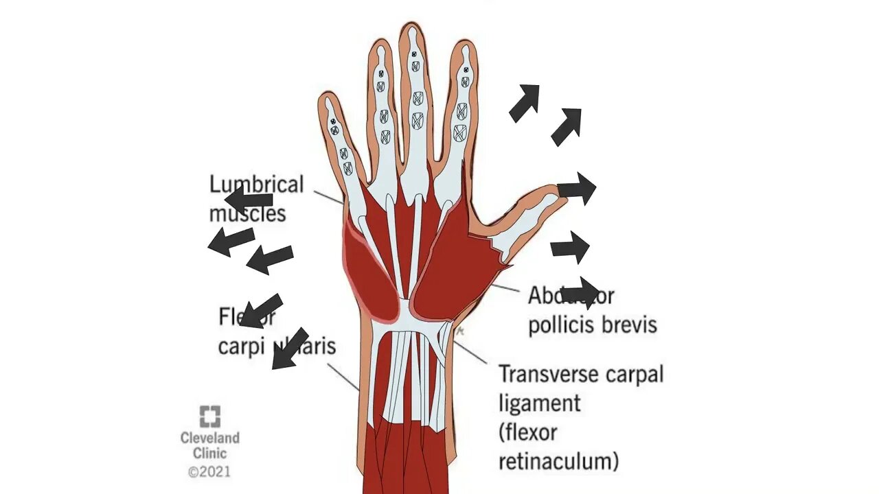 swelling in muscle of hand due arthritis