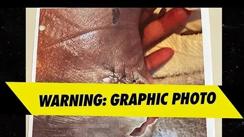 Leaked #Megantheestallion #Bloody SUV & #Bullet Wound Foot Photos