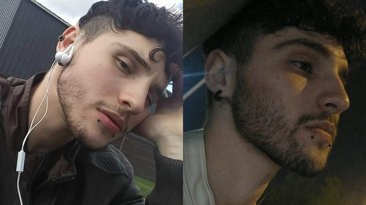 Minoxidil 6 Months Before & After Beard Results