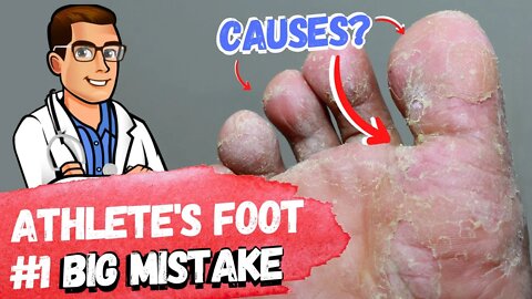 BEST 9 Athlete's Foot Fungus Remedies [& the #1 Big Mistake]