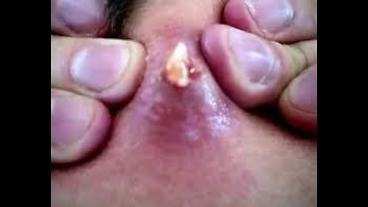 epic pimple pops