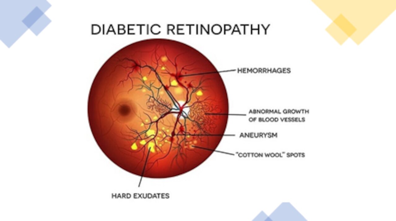 Diabetic Retinopathy - Natural Treatment