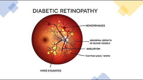 Diabetic Retinopathy - Natural Treatment