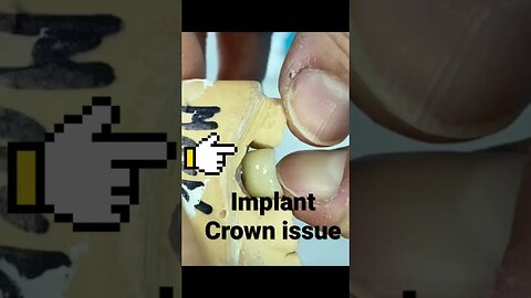 Implant Crown Issue