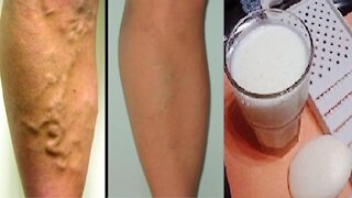 Home Remedy To Remove Varicose Veins and Thrombosis with Only 2 Simple Ingredients