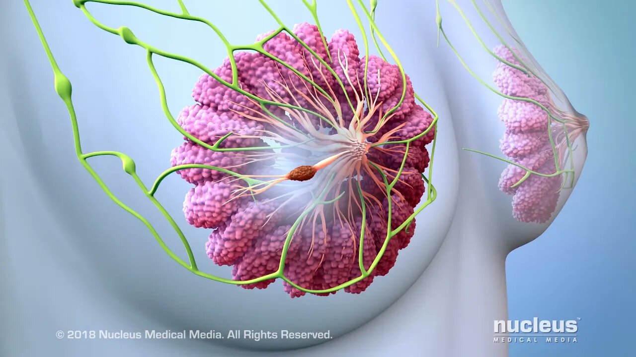 Opciones de tratamiento para el cáncer de mama