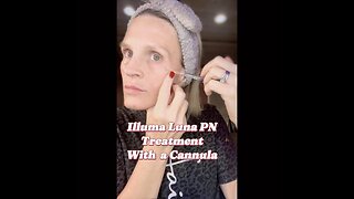 ✨ Illuma Luna PN Under-Eye Treatment Using a Cannula | My DIY Skincare Journey✨