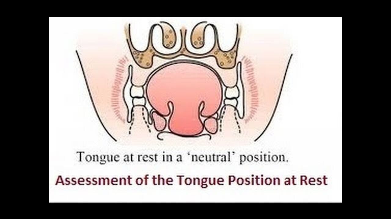 Assessment of the Tongue Position at Rest