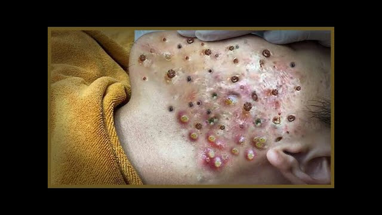 Blackheads Removal & Pimple Popper Cystic Acne Extraction Whiteheads Pimple Popping videos 103