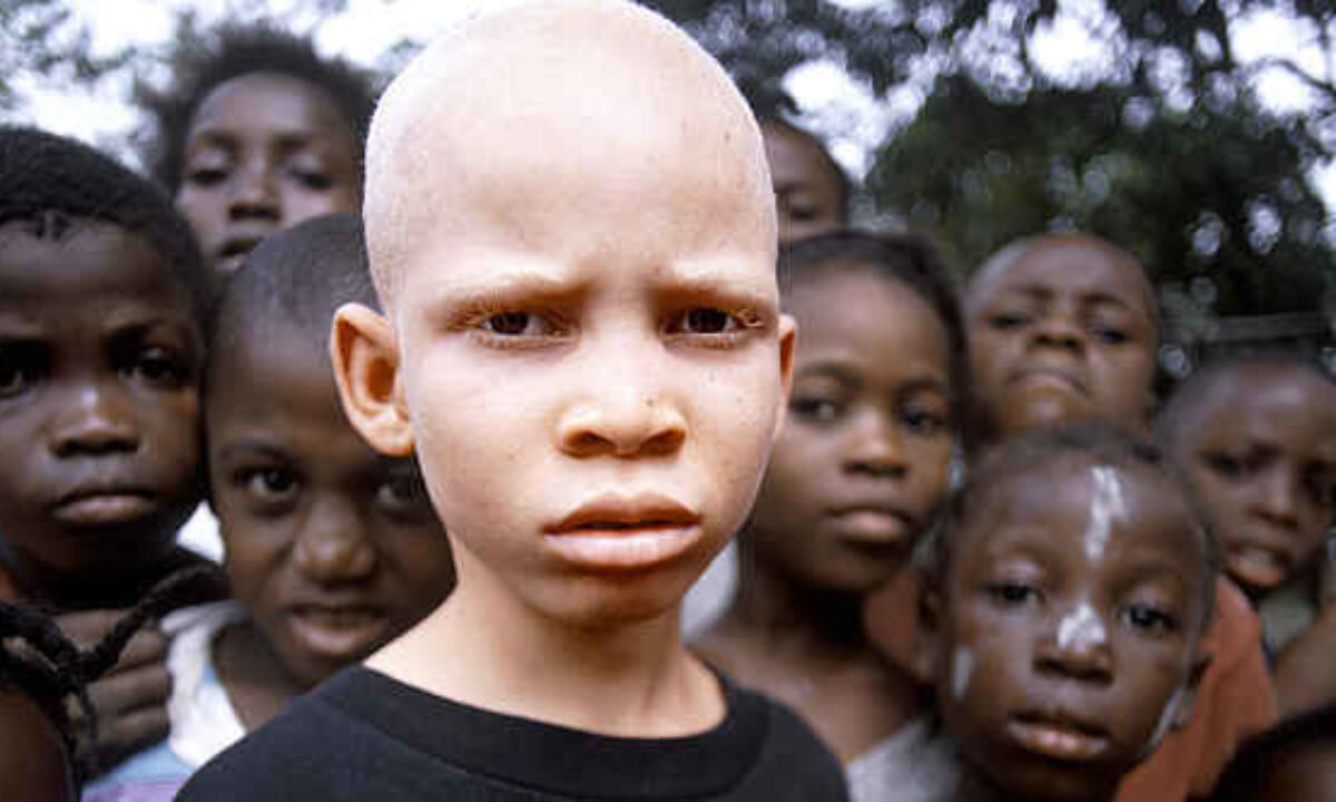 Alfred Speaks On The Upsurge Of The Ritual Killing Of Albinos In Tanzania