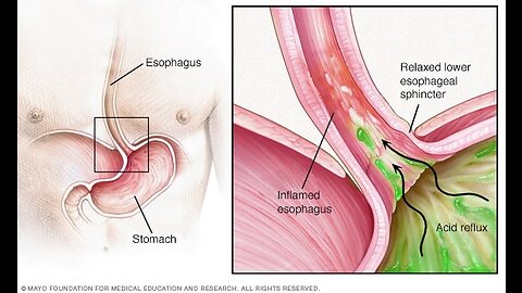 How to Prevent Acid Reflux, Heartburn Causes, and Acidic Foods to Avoid