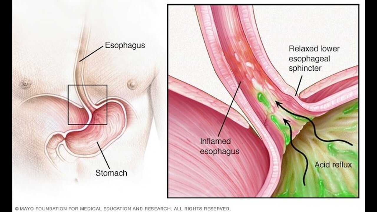 How to Prevent Acid Reflux, Heartburn Causes, and Acidic Foods to Avoid