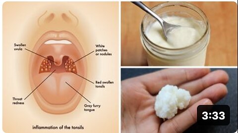 3 Powerful Home Remedies for Tonsil Stones That Work Fast! (Tonsilloliths)