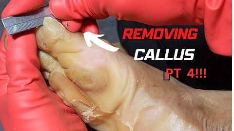 INTENSE CALLUS REMOVAL PT 4