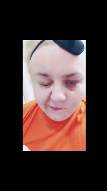 Facial paralysis case after mRNA experimental COVID "vaccines"