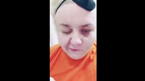 Facial paralysis case after mRNA experimental COVID "vaccines"