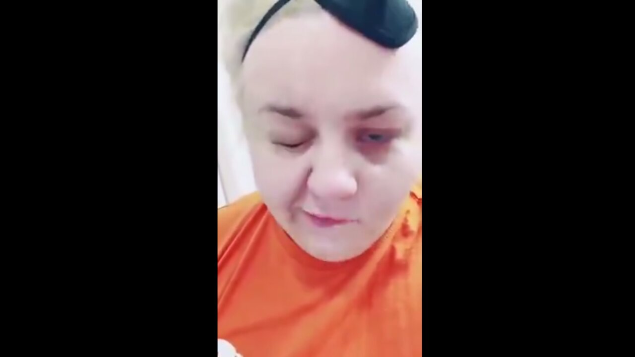 Facial paralysis case after mRNA experimental COVID "vaccines"