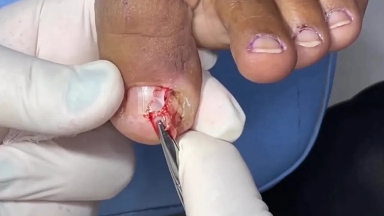 Unha encravada há muito tempo | Ingrown nail long time ago #podiatrist #ingrown_toenail #podologia