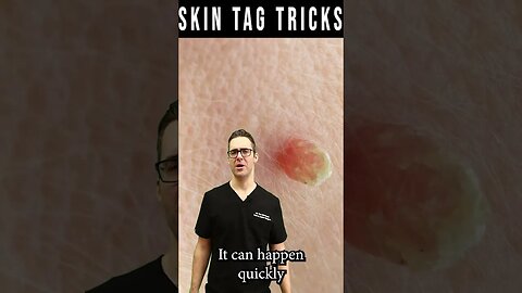 Skin Tag Removal & Plantar Wart Removal [Garlic, Iodine & Cider]