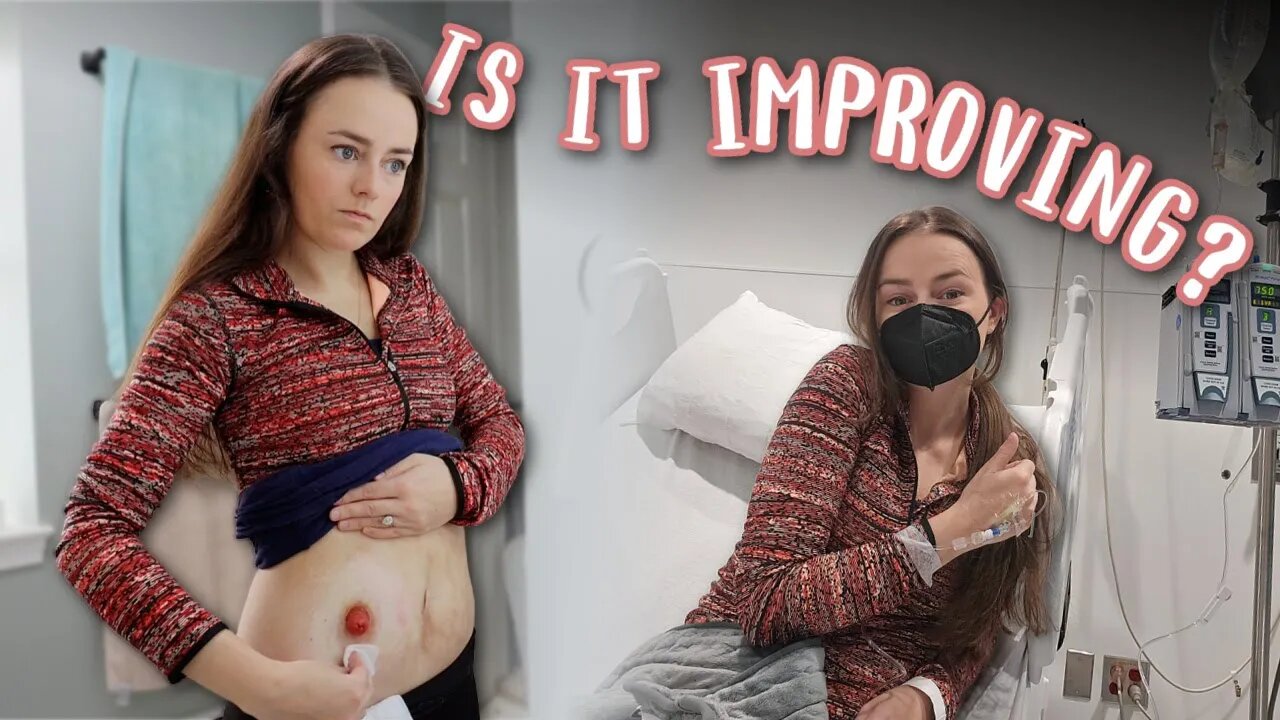 If It's SIBO, This Seems To Be Helping! | Let's Talk IBD