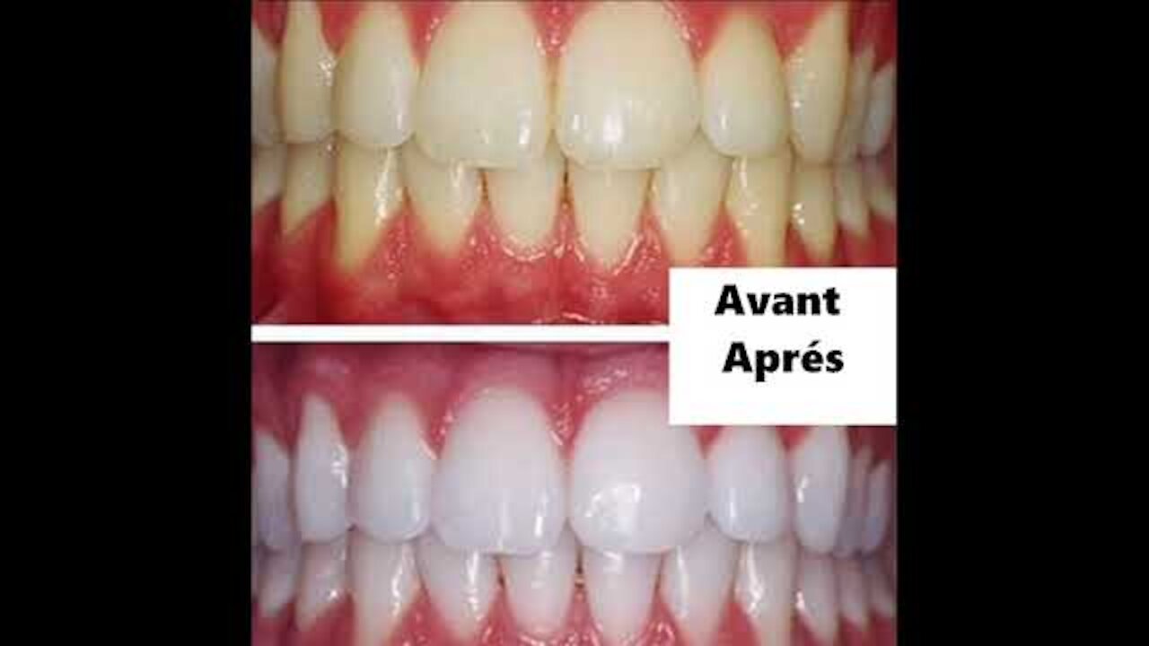 blanchiment des dents تبييض الأسنان في المنزل