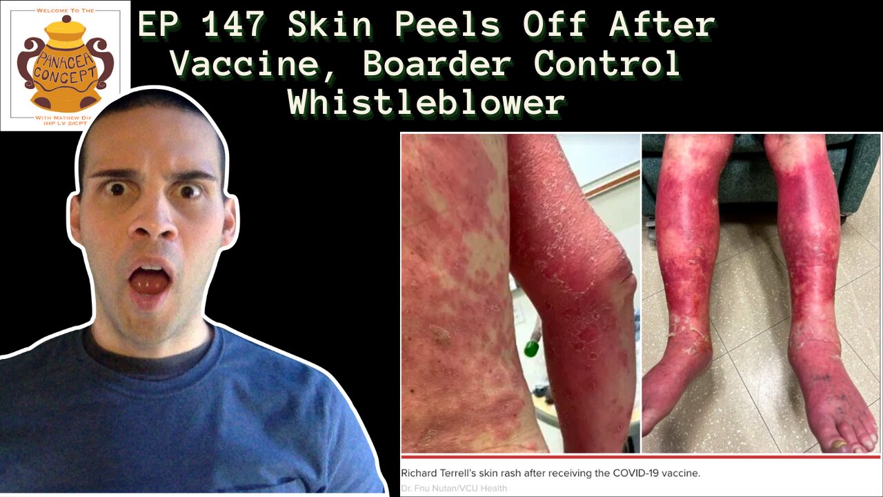 EP 147 Skin Peels Off After Vaccine, Boarder Control Whistleblower