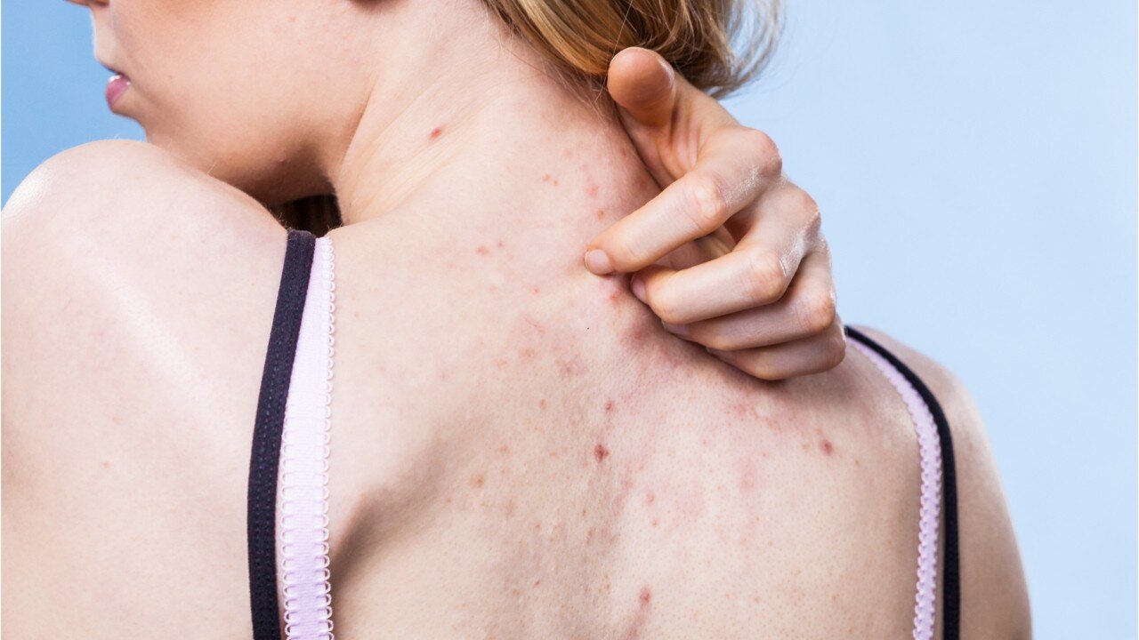 How To Conquer Body Acne