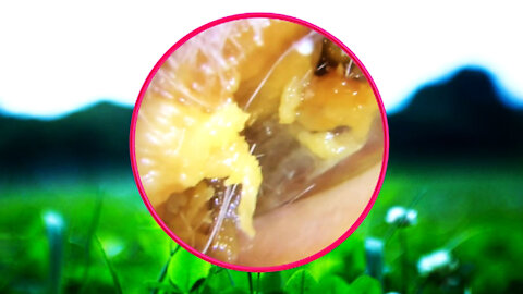 Ear Wax Removal With Clam Relaxing Music #21