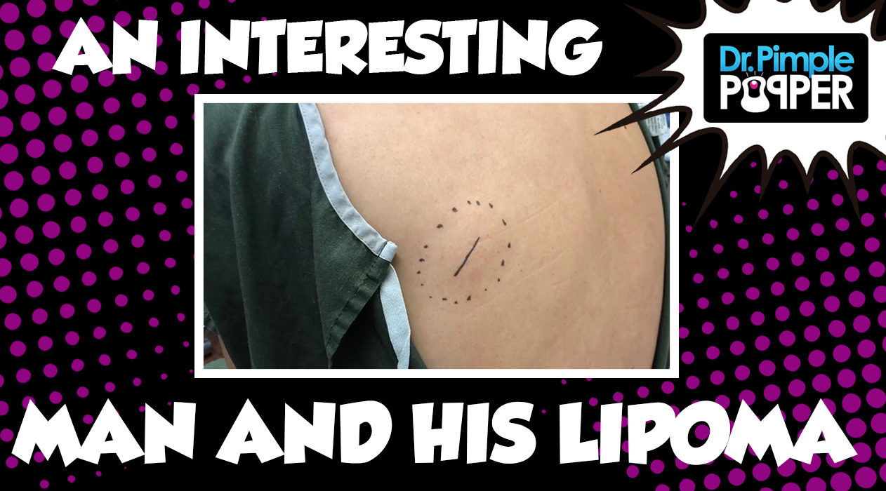 A Man as Interesting as his Lipoma