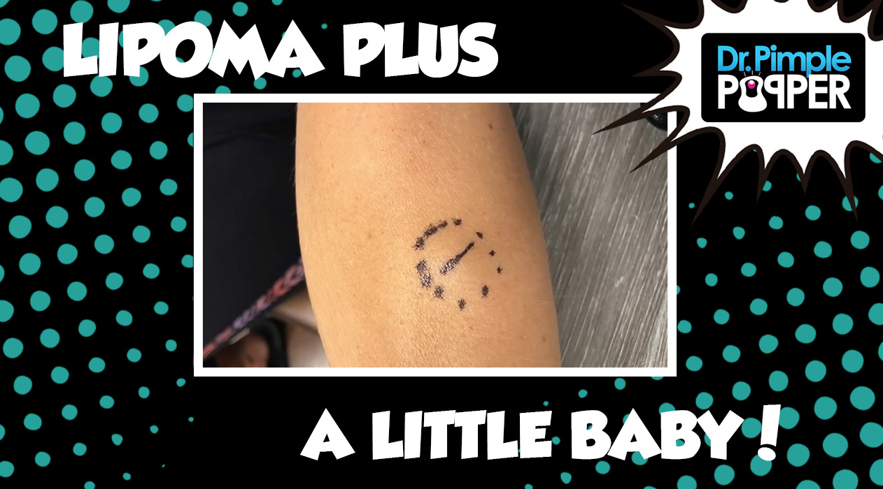 A Little Baby and a Lipoma