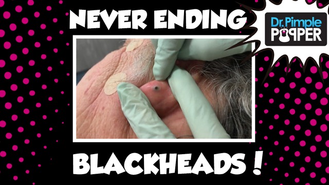 Never Ending Blackhead Surprises!