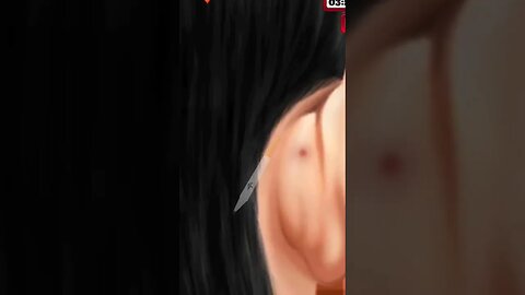 #ytshorts #viral #dangerous #Reshaping of the ear