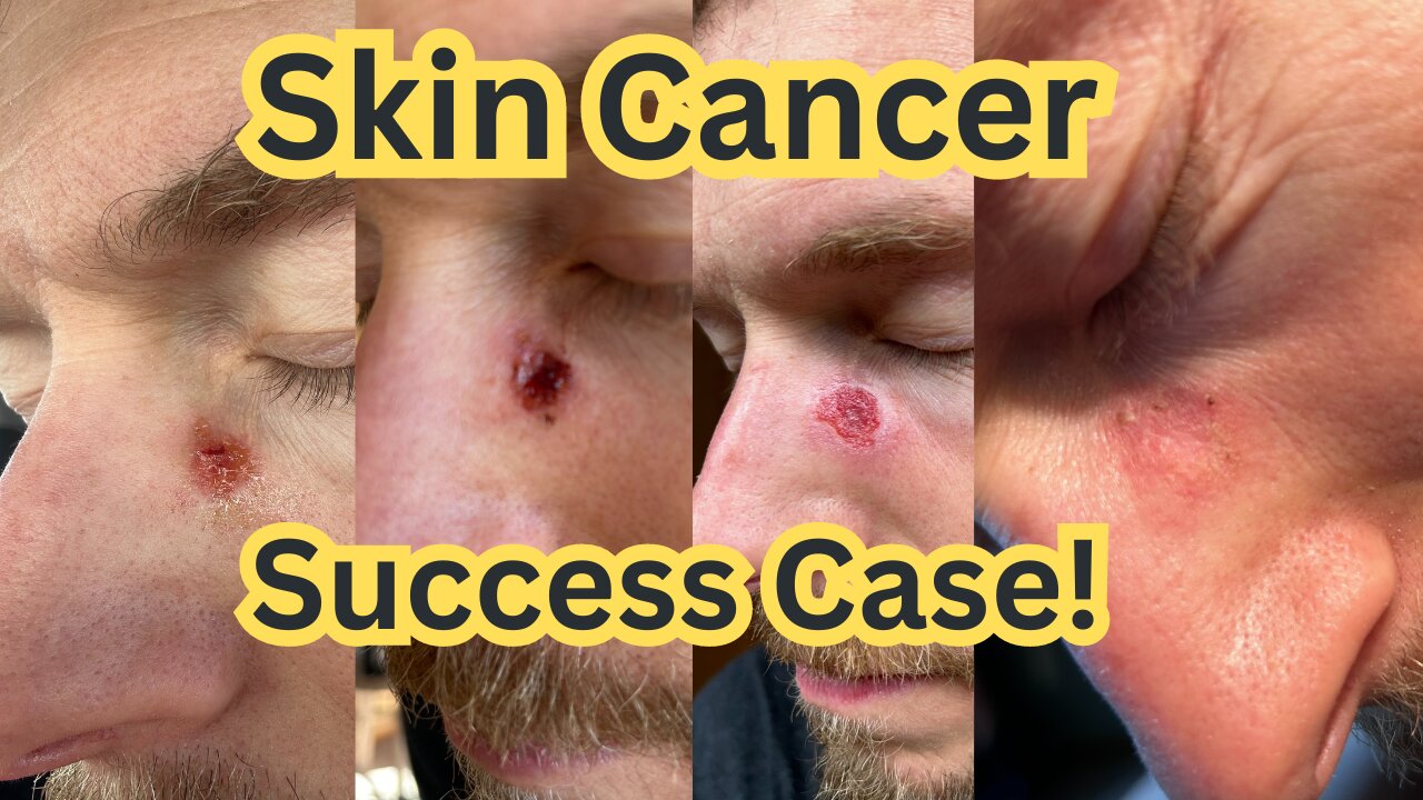 Skin Cancer Success Case