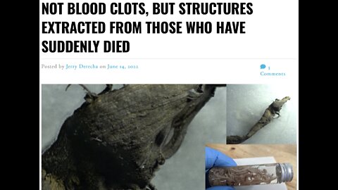 Not Blood Clots, But Structures Extracted From Those Who Have Suddenly Died – Fringe Culture