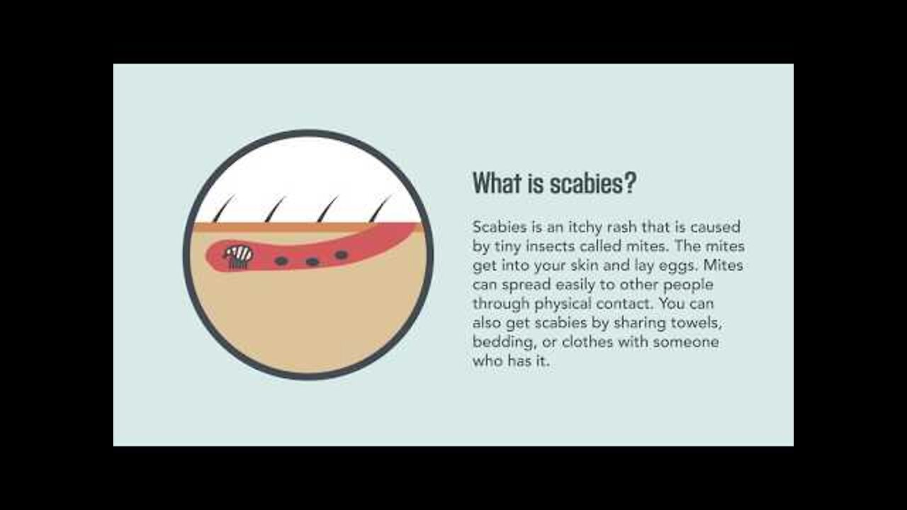 Scabies - Up Close & Personal