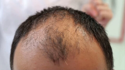 Balding and hair loss tied to air pollution in new study